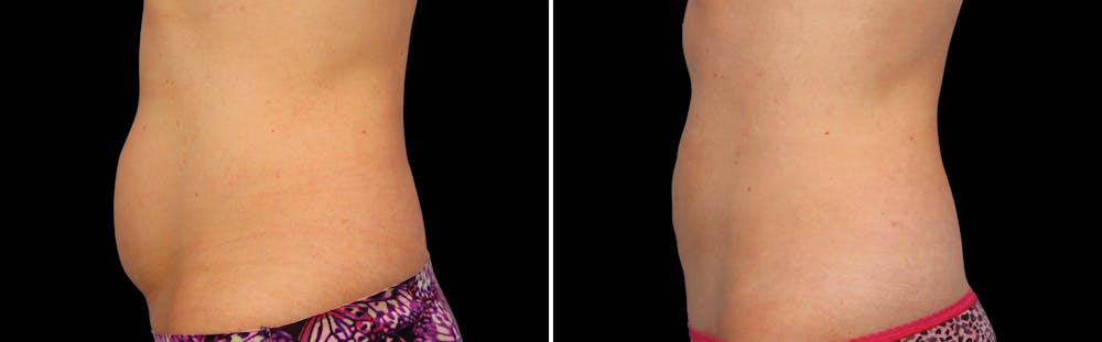 CoolSculpting Before & After Gallery - Patient 5750490 - Image 1