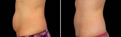 CoolSculpting Before & After Gallery - Patient 5750490 - Image 1