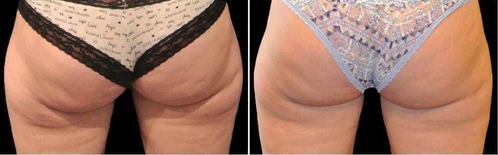 CoolSculpting Before & After Gallery - Patient 5750489 - Image 1