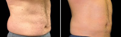 CoolSculpting Before & After Gallery - Patient 5750488 - Image 1