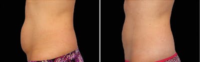 CoolSculpting Before & After Gallery - Patient 5750487 - Image 1