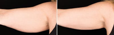 CoolSculpting Before & After Gallery - Patient 5750486 - Image 1