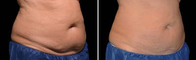 CoolSculpting Before & After Gallery - Patient 5750485 - Image 1