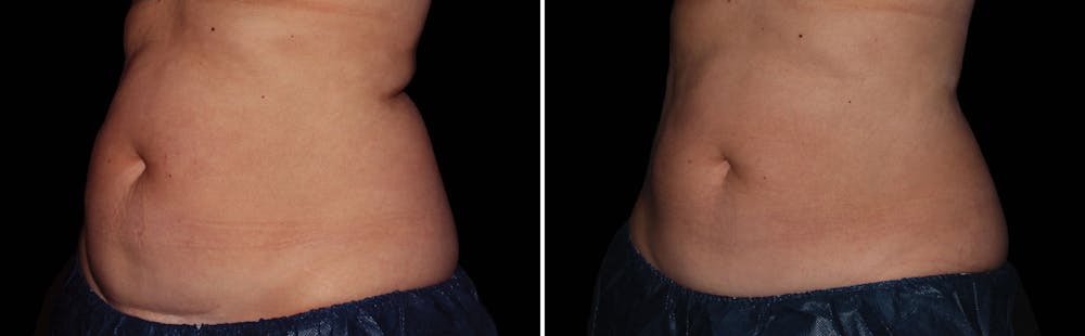 CoolSculpting Before & After Gallery - Patient 5750484 - Image 1