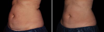 CoolSculpting Gallery - Patient 5750484 - Image 1