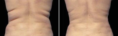 CoolSculpting Before & After Gallery - Patient 5750483 - Image 1