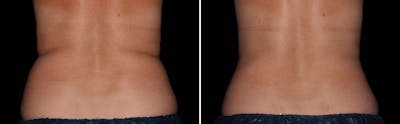 CoolSculpting Before & After Gallery - Patient 5750482 - Image 1