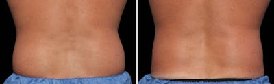 CoolSculpting Before & After Gallery - Patient 5750481 - Image 1