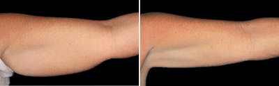 CoolSculpting Before & After Gallery - Patient 5750480 - Image 1