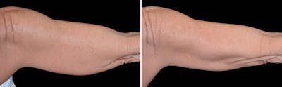 CoolSculpting Before & After Gallery - Patient 5750479 - Image 1