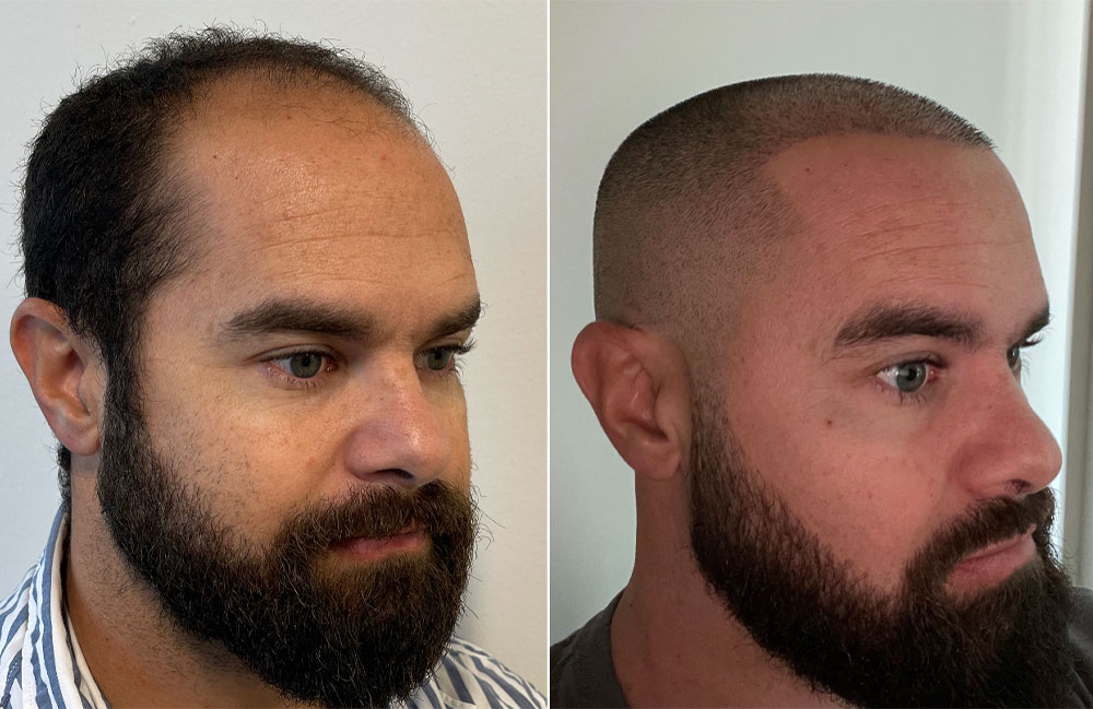 before and after fue hair transplant dallas