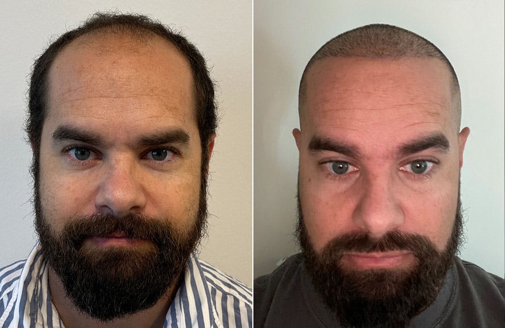 Hair Restoration Before & After Gallery - Patient 67806463 - Image 2