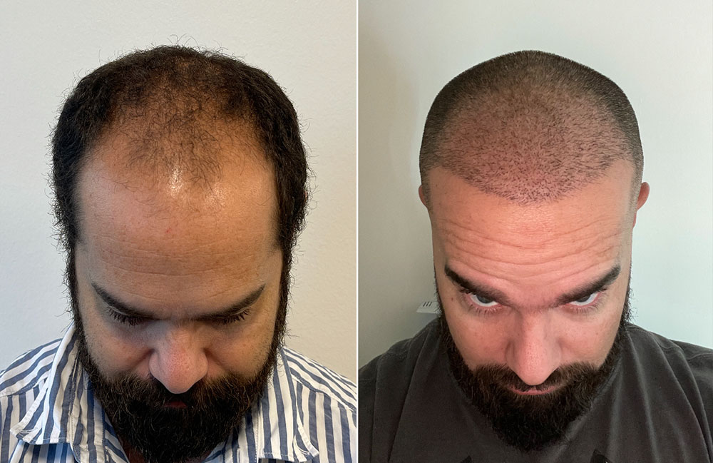 before and after hair transplant fort worth