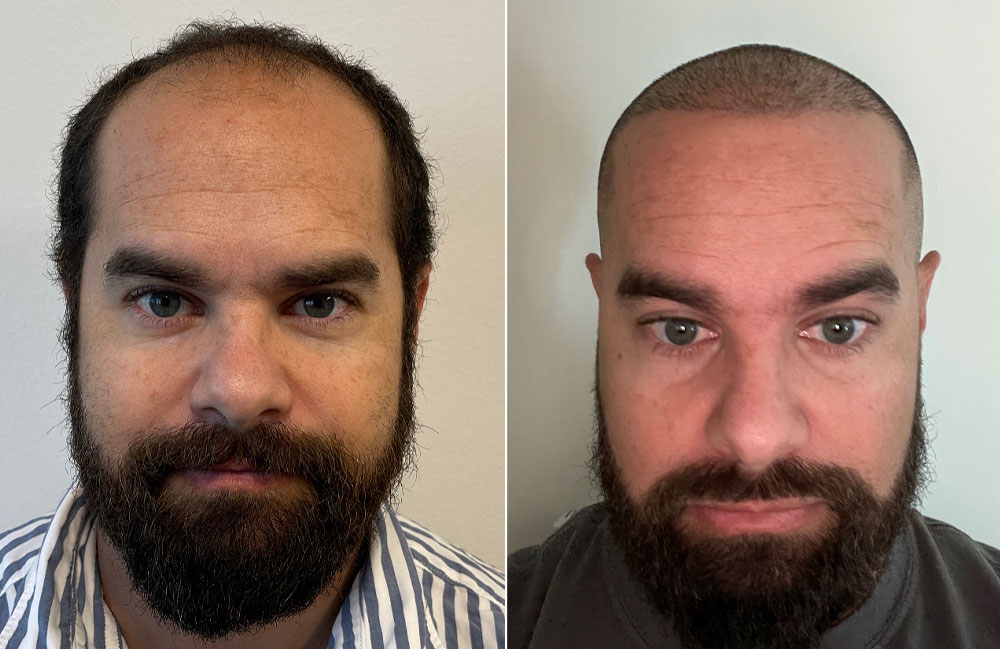 before and after hair transplant grapevine