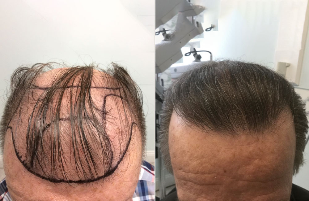 before and after hair transplant grapevine