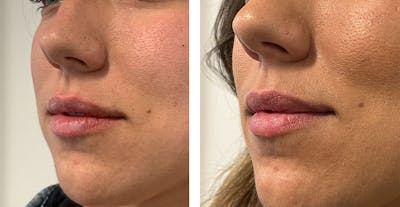 BOTOX & Fillers Before & After Gallery - Patient 122529588 - Image 1