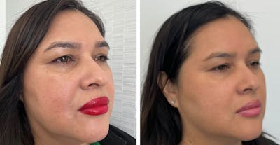 BOTOX & Fillers Before & After Gallery - Patient 122529605 - Image 1