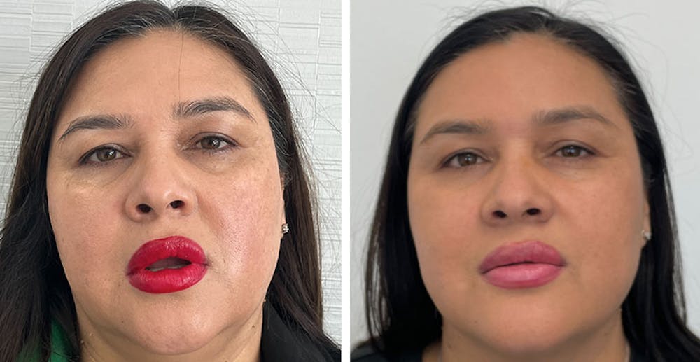 BOTOX & Fillers Before & After Gallery - Patient 122529620 - Image 1