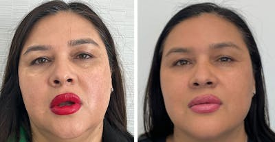 BOTOX & Fillers Before & After Gallery - Patient 122529620 - Image 1