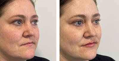 BOTOX & Fillers Before & After Gallery - Patient 122529637 - Image 1