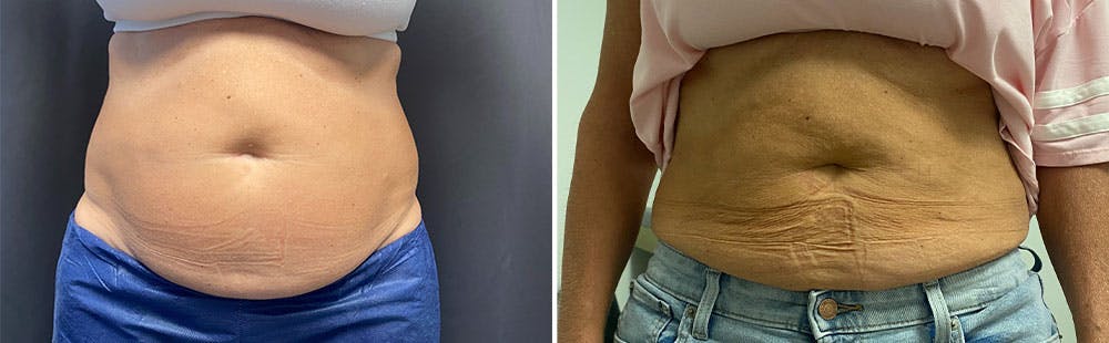 CoolSculpting Before & After Gallery - Patient 122529667 - Image 1