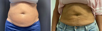 CoolSculpting Before & After Gallery - Patient 122529667 - Image 1
