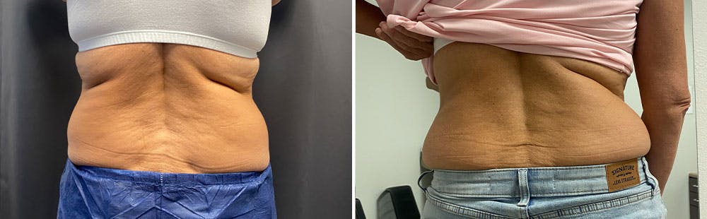 CoolSculpting Before & After Gallery - Patient 122529716 - Image 1