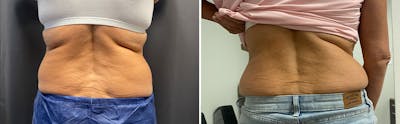 CoolSculpting Before & After Gallery - Patient 122529716 - Image 1