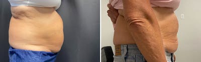 CoolSculpting Before & After Gallery - Patient 122529795 - Image 1