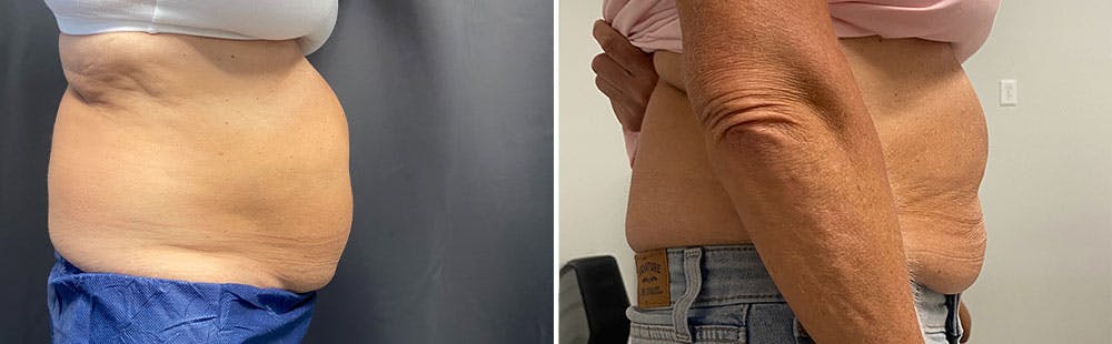 CoolSculpting Before & After Gallery - Patient 122529795 - Image 1