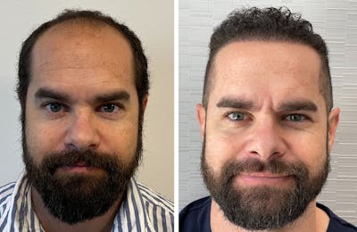 Hair Restoration Before & After Gallery - Patient 122529967 - Image 1