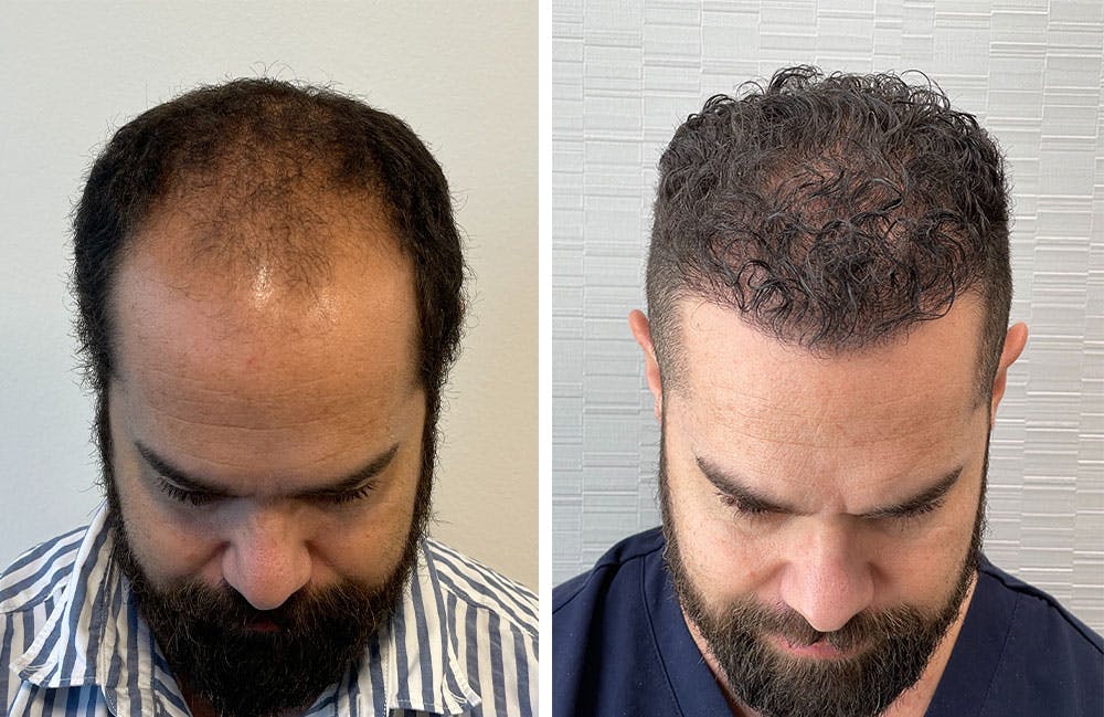 Hair Restoration Before & After Gallery - Patient 122529966 - Image 1