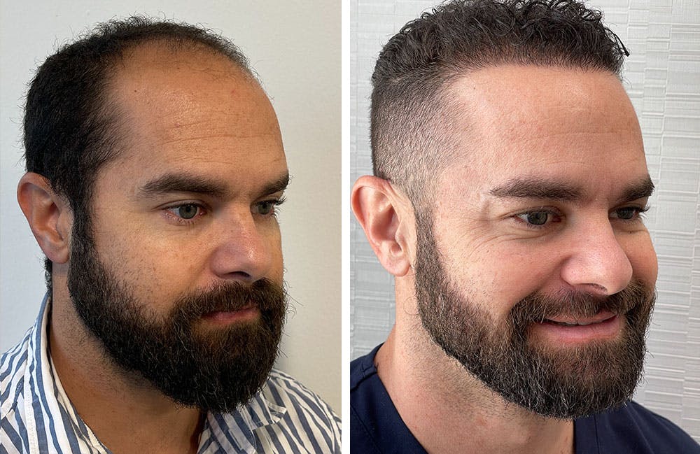 Hair Restoration Before & After Gallery - Patient 122529965 - Image 1