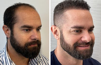 Hair Restoration Before & After Gallery - Patient 122529965 - Image 1