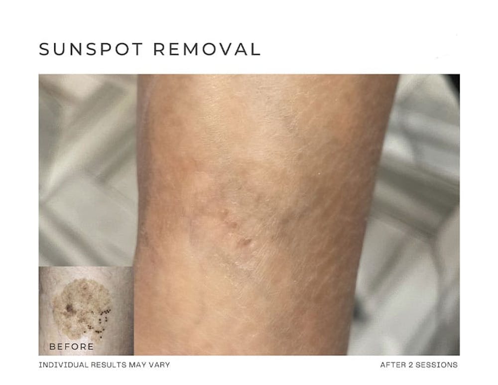Fibroblast Before & After Gallery - Patient 146528387 - Image 1