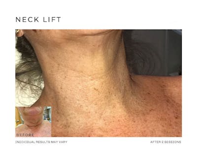 Fibroblast Before & After Gallery - Patient 146528388 - Image 1