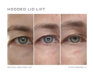 Fibroblast Before & After Gallery - Patient 146528393 - Image 1