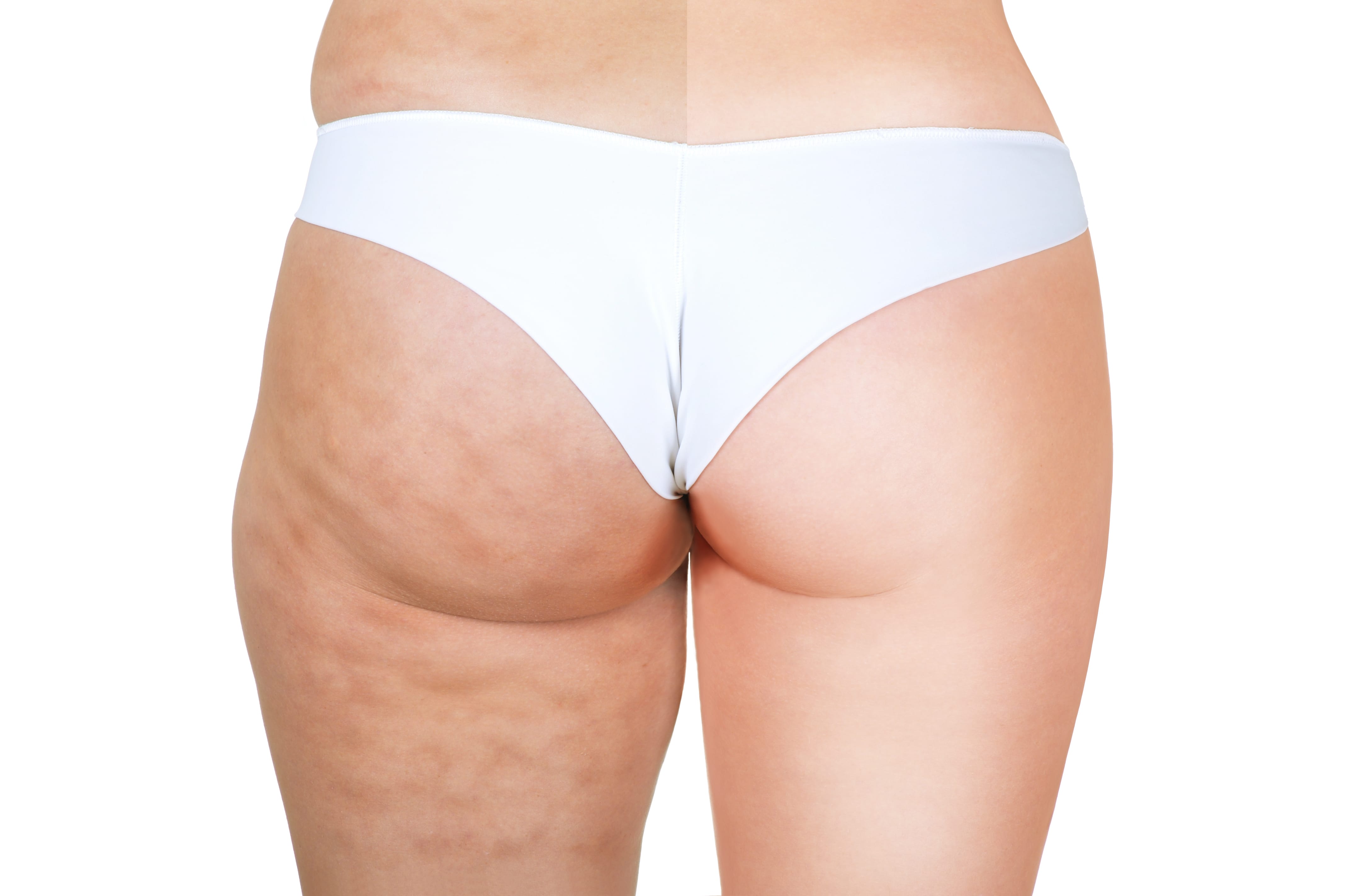 Before and after photos of a woman's legs showcasing the results of Exion treatment at Genesis Lifestyle Medicine.