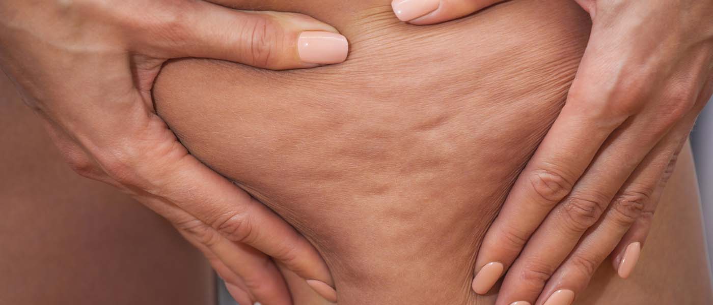 Woman showing visible cellulite, suitable candidate for CoolTone treatment at Genesis Lifestyle Medicine.