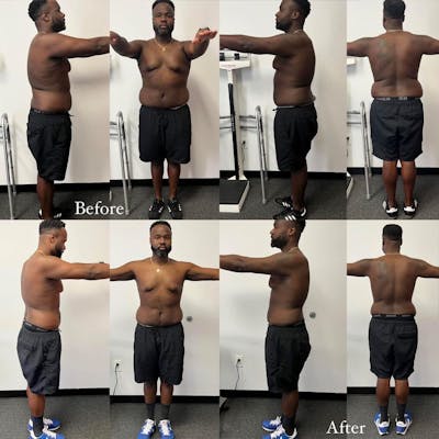 Weight Loss Before & After Gallery - Patient 295405 - Image 2