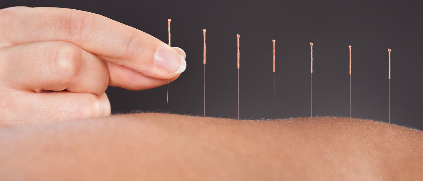 Acupuncture needles depicted by Genesis Lifestyle Medicine.