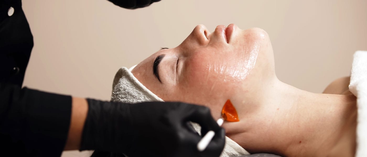 woman getting a chemical peel treatment