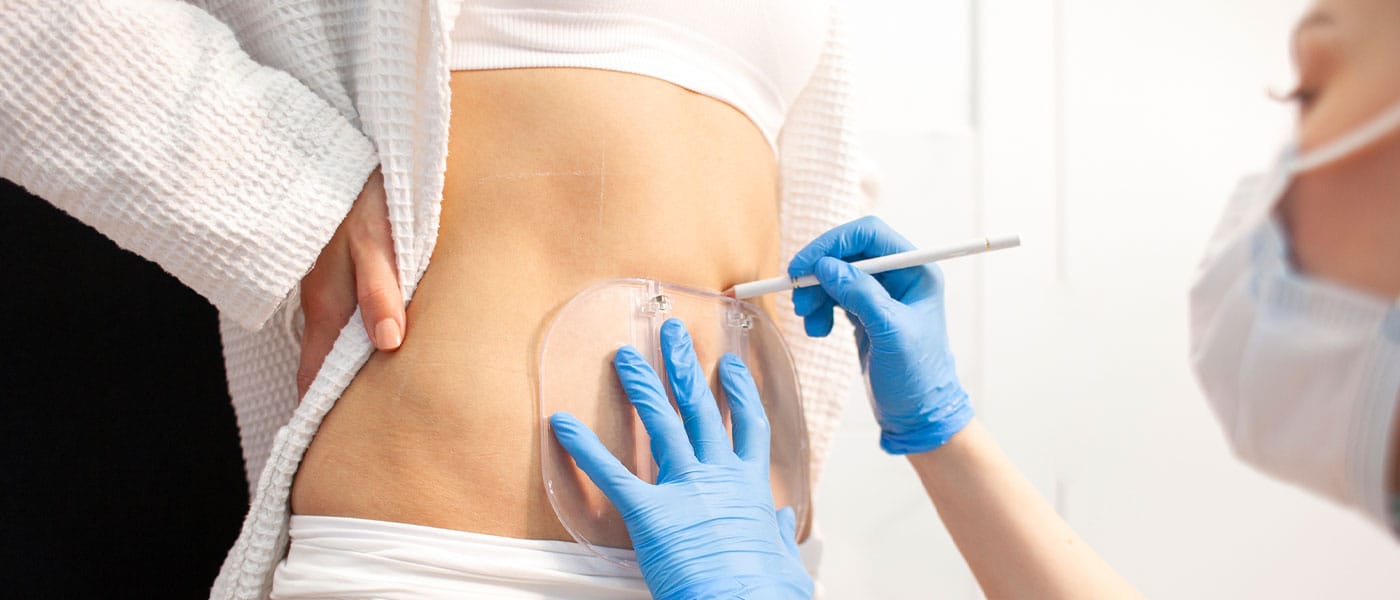 woman during a consultation for her coolsculpting treatment
