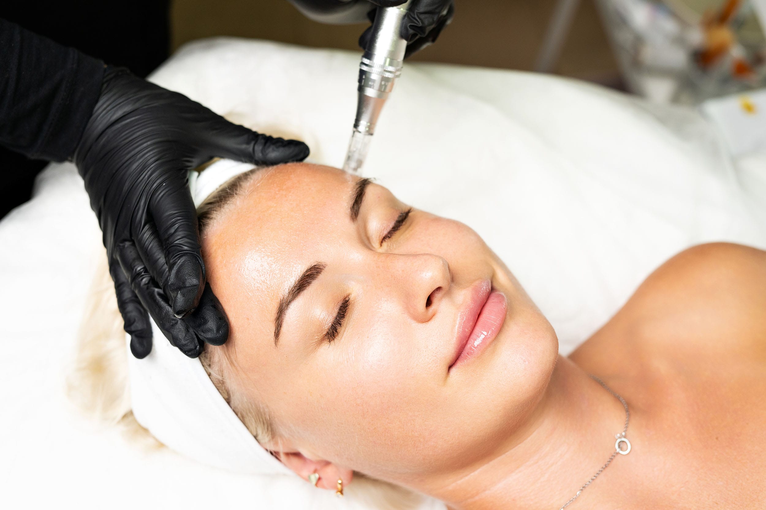 Genesis Lifestyle Medicine Blog | Microneedling FAQ: What Patients Want to Know