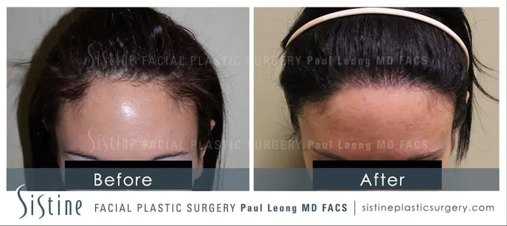 Hair Transplant Before & After Gallery - Patient 5468702 - Image 1