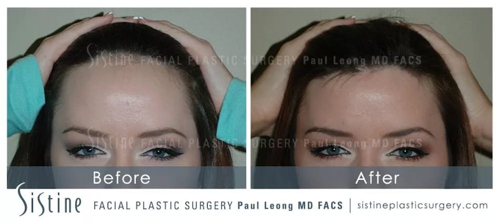 Hair Transplant Before & After Gallery - Patient 5468703 - Image 1