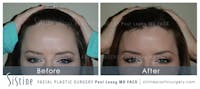 Hair Transplant Before & After Gallery - Patient 5468703 - Image 1