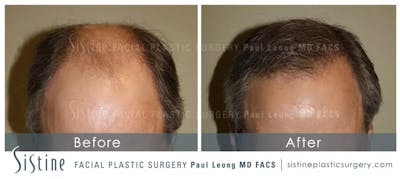 Before & After