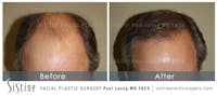 Hair Transplant Before & After Gallery - Patient 5468705 - Image 1