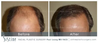 Hair Transplant Before & After Gallery - Patient 5468705 - Image 1